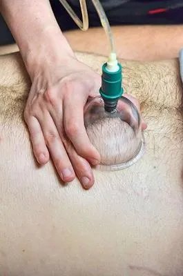 拔罐以后多久能洗澡呢