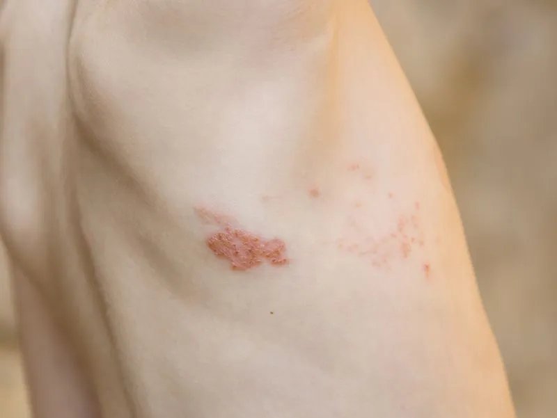 人类疱疹病毒需注意什么