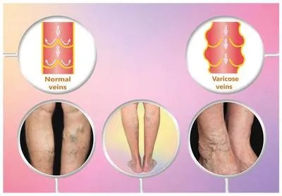 增生性瘢痕的饮食注意事项有哪些