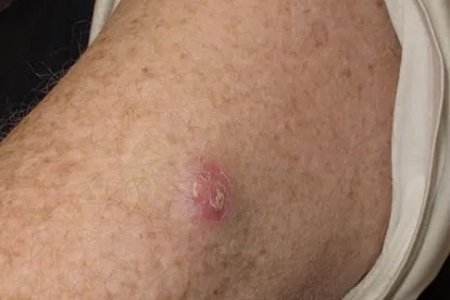 胳膊上的皮肤癌图片