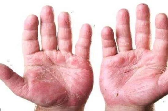 什么是肝掌及特征图片