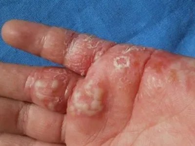 单纯疱疹水疱图片