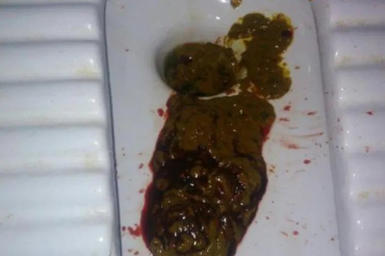 拔毛癖严重后果是什么样的