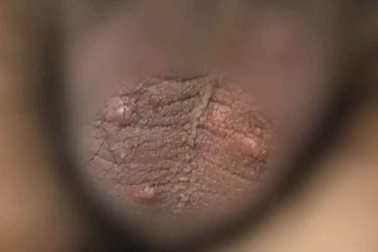 疥疮阴囊疙瘩图片