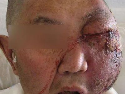 蜂窝织炎红肿图片