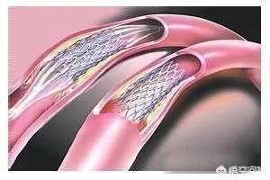 在未来,能做全身的血管支架手术吗?