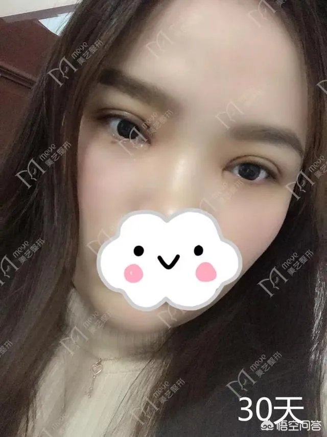 做双眼皮有几种方法？