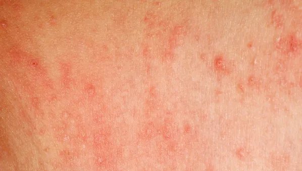 湿疹用什么药膏最好