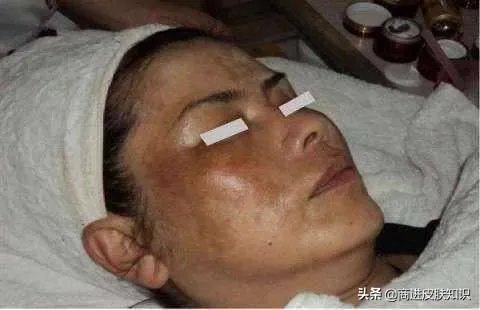 黄褐斑长什么样图片？