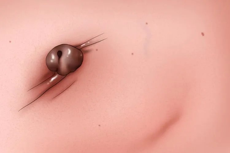 乳腺酒窝征图片