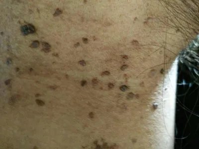 皮肤纤维瘤结节图片