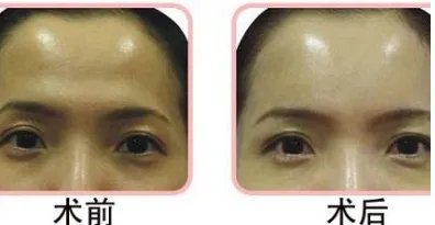 上海面部脂肪填充医院哪里好？