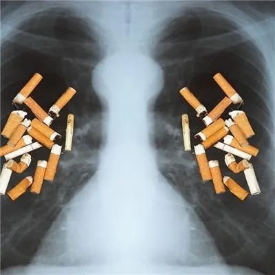 肺癌晚期还有救吗