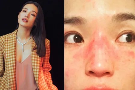 舒淇自曝曾被嫌丑 晒过敏照片令人心疼