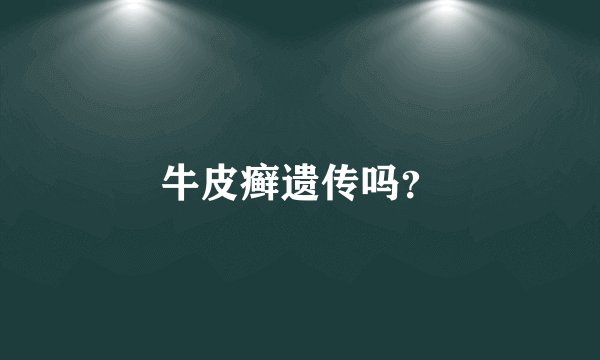 牛皮癣遗传吗？