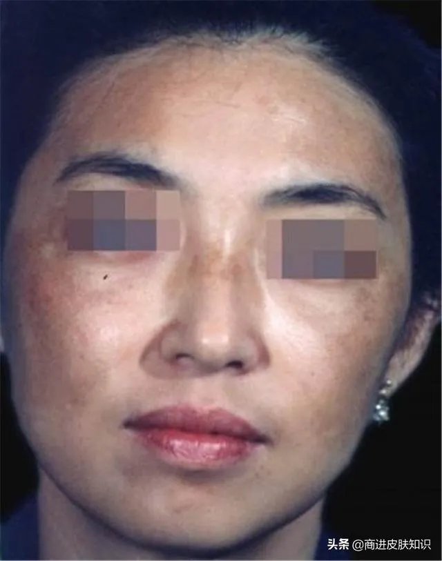 黄褐斑长什么样图片？