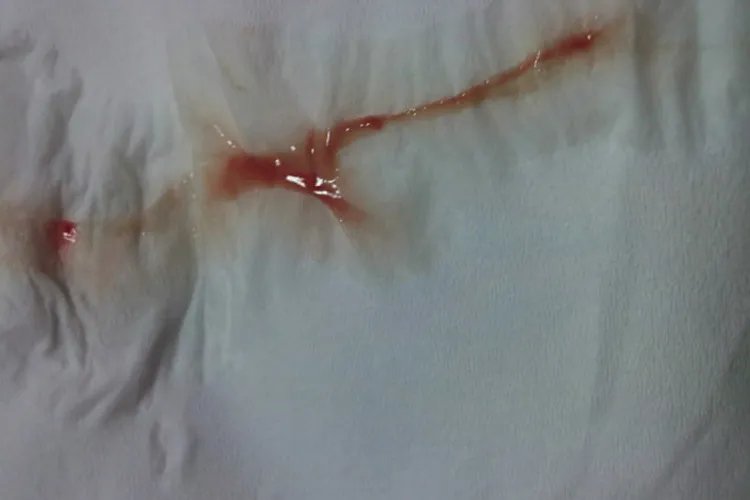 宫颈癌同房后出血特点图片