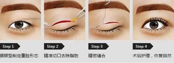 做双眼皮有几种方法？