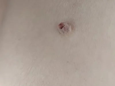 皮肤纤维瘤结节图片