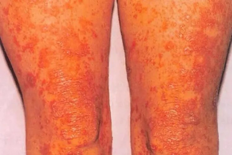 毛发红糠疹大腿症状图片