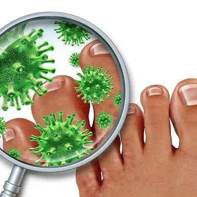 治疗牛皮癣应该怎么办