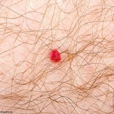 治疗阴虱病什么药物疗效好