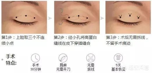 做双眼皮有几种方法？