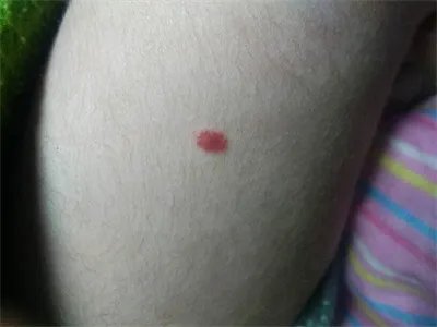 弥漫性躯体性血管角化瘤丘疹图片