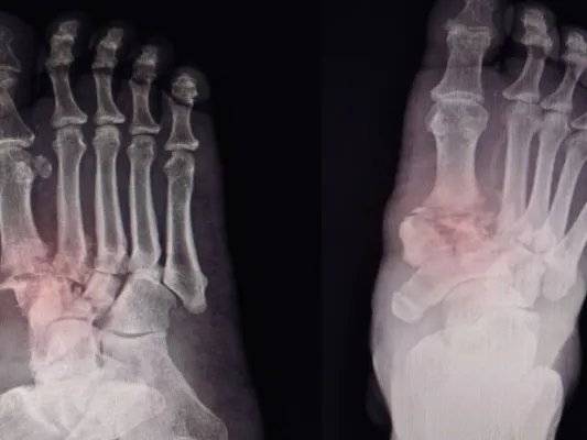 骨折后的注意事项