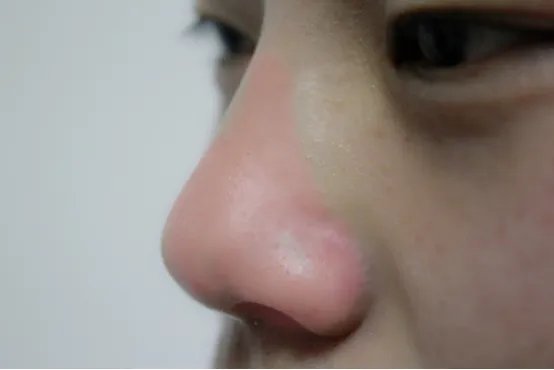 单侧鼻子出血会是癌症吗