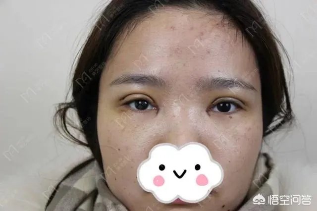 做双眼皮有几种方法？