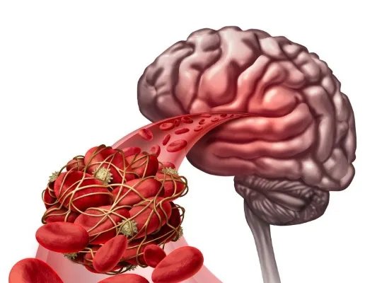 脑血栓吃什么食物好