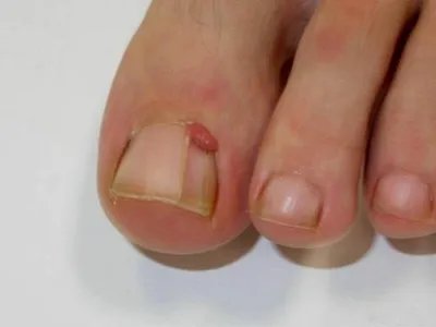 皮肤纤维瘤结节图片