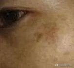 黄褐斑长什么样图片？