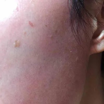 扁平尤是什么原因?