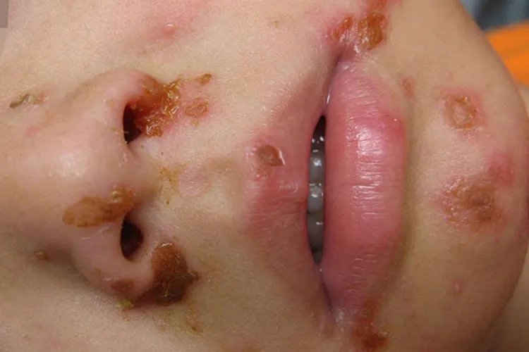 黄皮疮症状的图片