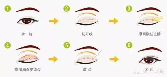 做双眼皮有几种方法？