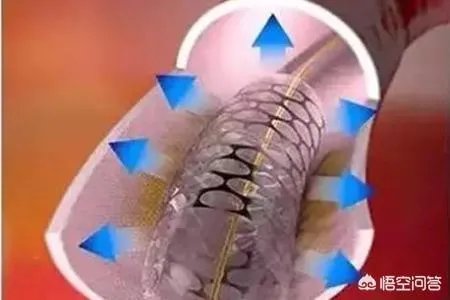在未来，能做全身的血管支架手术吗？