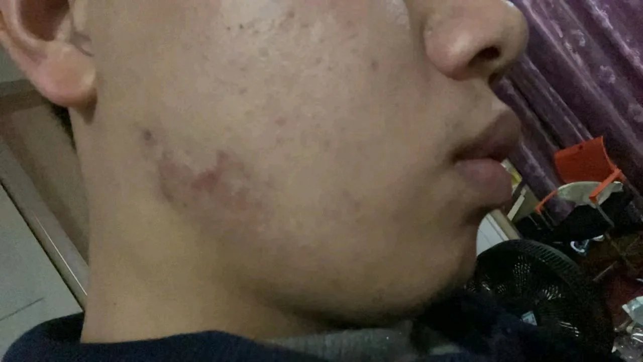 疤痕疙瘩同位素敷贴治疗过时了吗？听听核医学医生怎么讲