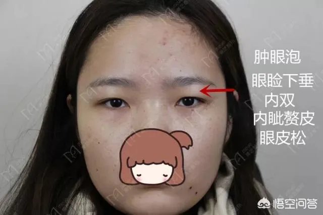 做双眼皮有几种方法？