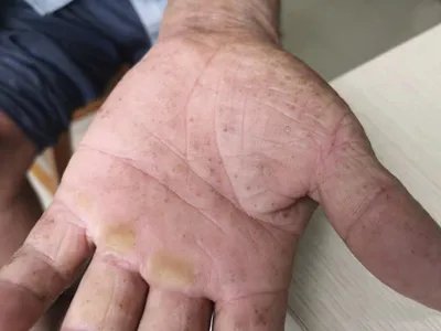 刺激性接触性皮炎皮肤增厚图片