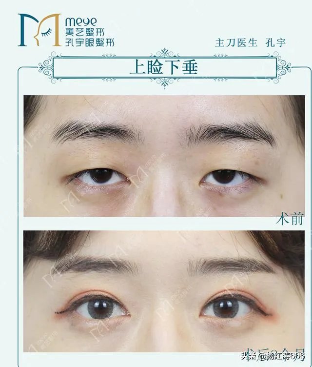 做双眼皮有几种方法？