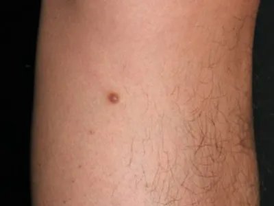 皮肤纤维瘤结节图片