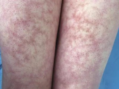 马歇尔-怀特综合征症状图片