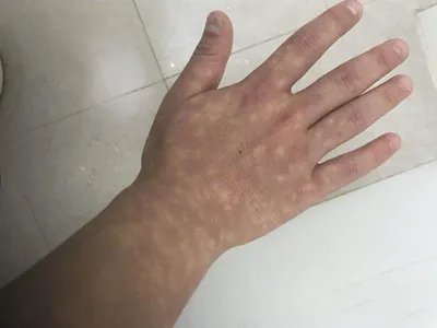 马歇尔-怀特综合征症状图片