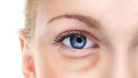 去眼袋的最好方法