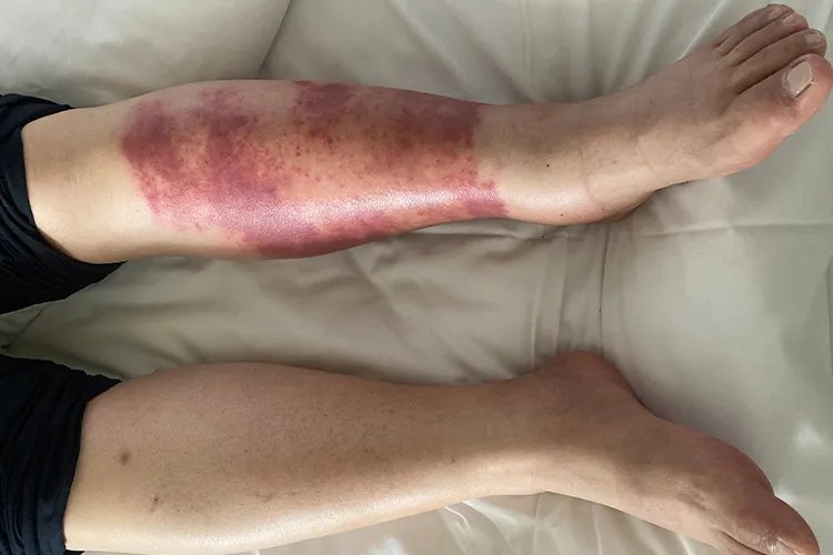 丹毒早期症状图片