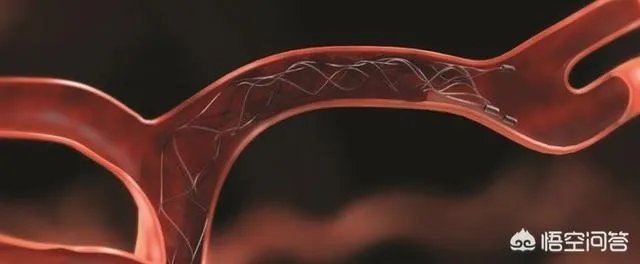 在未来,能做全身的血管支架手术吗?