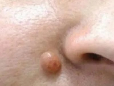 皮肤纤维瘤结节图片