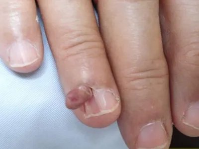 皮肤纤维瘤结节图片